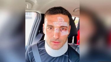 Scaloni recibió el alta tras ser atropellado por un auto en Mallorca
